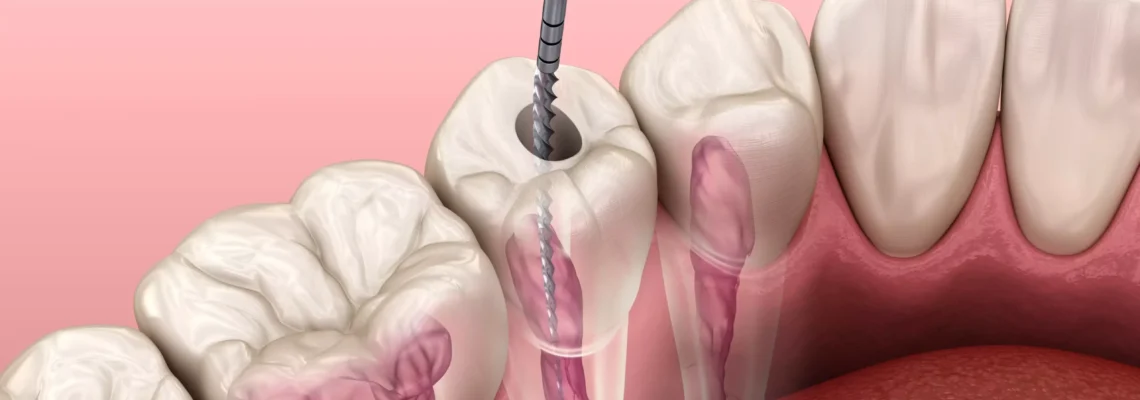 بهترین متخصص درمان ریشه در تهرانپارس | دکتر مسعود شاه‌حسینی